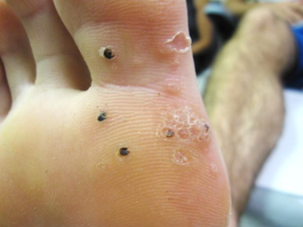 wart on foot with black center