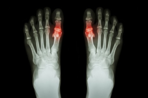 Definition and Causes of Juvenile Gout