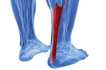 Achilles tendon treatment in the Ventura County, CA: Thousand Oaks (Simi Valley, Camarillo, Moorpark, Oak Park) and Los Angeles County, CA: Calabasas, Cornell, Agoura Hills areas