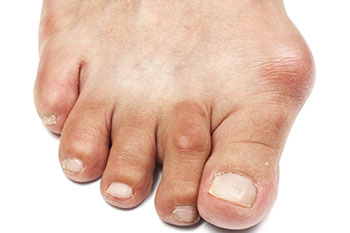 Bunions treatment in the Ventura County, CA: Thousand Oaks (Simi Valley, Camarillo, Moorpark, Oak Park) and Los Angeles County, CA: Calabasas, Cornell, Agoura Hills areas