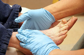 Diabetic foot treatment in the Ventura County, CA: Thousand Oaks (Simi Valley, Camarillo, Moorpark, Oak Park) and Los Angeles County, CA: Calabasas, Cornell, Agoura Hills areas