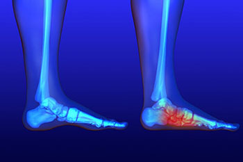 Flat feet treatment in the Ventura County, CA: Thousand Oaks (Simi Valley, Camarillo, Moorpark, Oak Park) and Los Angeles County, CA: Calabasas, Cornell, Agoura Hills areas