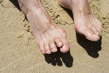 Hammertoe Treatment in the Ventura County, CA: Thousand Oaks (Simi Valley, Camarillo, Moorpark, Oak Park) and Los Angeles County, CA: Calabasas, Cornell, Agoura Hills areas