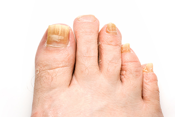 Toenail fungus treatment in the Ventura County, CA: Thousand Oaks (Simi Valley, Camarillo, Moorpark, Oak Park) and Los Angeles County, CA: Calabasas, Cornell, Agoura Hills areas