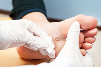 Warts treatment in the Ventura County, CA: Thousand Oaks (Simi Valley, Camarillo, Moorpark, Oak Park) and Los Angeles County, CA: Calabasas, Cornell, Agoura Hills areas