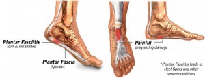 Plantar Fasciitis in Thousand Oaks and Agoura Hills