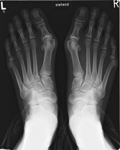 X-ray of bunions showing swelling